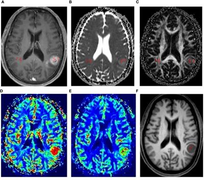 Noninvasive assessment of Ki-67 labeling index in glioma patients based on multi-parameters derived from advanced MR imaging